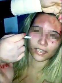 Agressora queima rosto da v�tima com cigarro por causa de namorado