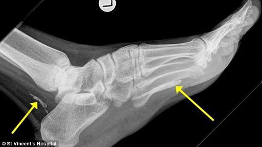 Midianews Apos Um Exame De Raio X Homem Descobre Verme Africano Em Seu Pe