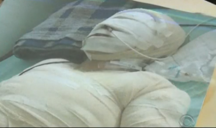 Maria teve 40% do corpo queimado e ainda est internada em Joinville