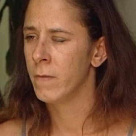 Mulher fica com olho grudado aps amigo pingar supercola em vez de colrio