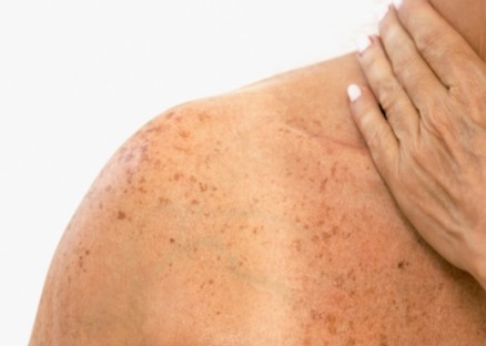 O estrago  cumulativo e, ao longo dos anos, ele pode se consolidar como um tumor