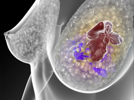 Cncer de mama triplo-negativo  a forma mais agressiva de cncer de mama e o nico tipo de tumor de mama que ainda no tem uma terapia-alvo; estudo demonstram que um inibidor de JAK2 como uma possvel terapia especfica 