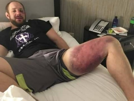 Torgeson mostra a parte interna da coxa esquerda completamente roxa aps a luta contra Thiago Silva