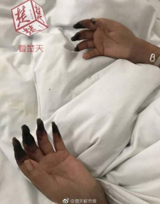 Dedos infectados de chinesa aps faxina