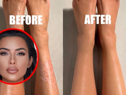 Kim Karashian mostra como cobre a psorase na perna