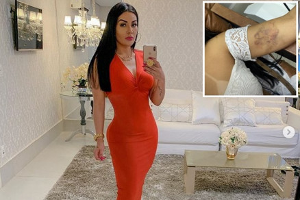 Carla Bora compartilhou hematoma em seu perfil no Instagram
