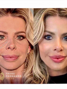 Resultado do preenchimento labial de Karina Bacchi 