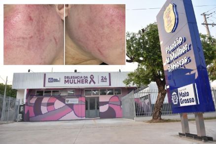 Marcas deixada pelo homem no rosto da mulher (detalhe)