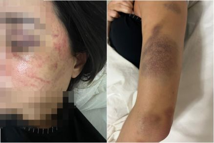 A v�tima disse ter sido agredida com socos e apresentava hematomas pelo corpo 