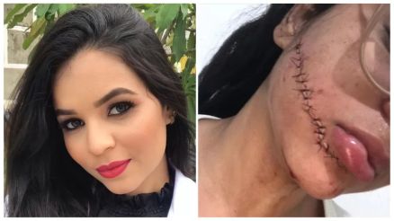 A estudante de enfermagem Stefani Firmino, 23, estava dormindo no nibus quando sentiu o rosto doer