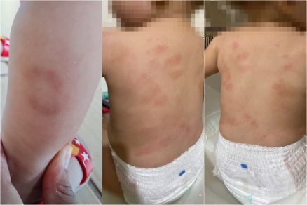 Me encontrou marca de 'tapo' nas costas da filha; mordida aconteceu em maro