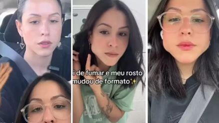 Carol Ribeiro sofreu hipertrofia no masseter por conta do uso cont�nuo de chicletes