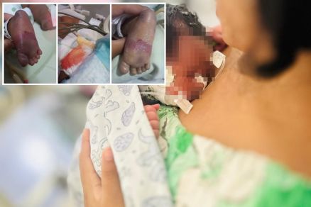 Raiany Carvalho segurando o filho Ncolas; em detalhe algumas das leses 