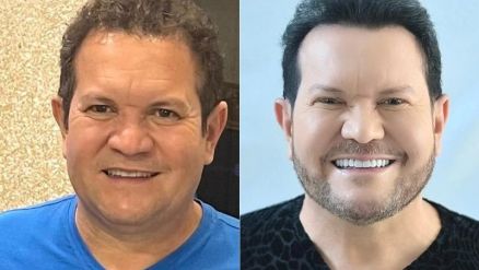 Ximbinha mostrou antes e depois de lipo de papada e rinoplastia