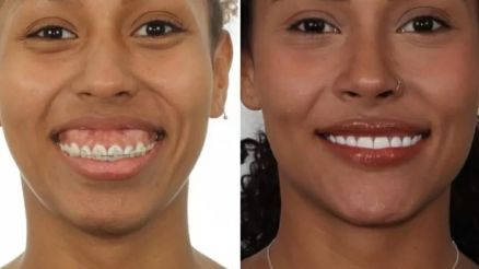 Resultado de cirurgia em Giovanna Jacobina, participante do BBB 25 (Globo) - Veja mais em https://www.uol.com.br/splash/noticias/2025/01/20/bbb-25-cirurgia-expoe-antes-e-depois-de-giovanna-desconforto-estetico.htm?cmpid=copiaecola