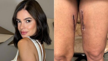 Vera Viel contou que n�o pretende tirar cicatriz ap�s vencer tipo raro de tumor 