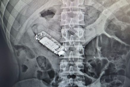 Celular encontrado no exame de raios-X do detento 