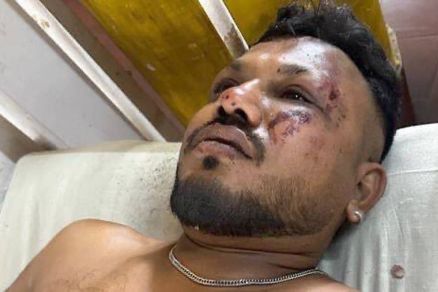 Um homem est deitado em uma cama de hospital, com o rosto machucado e hematomas visveis. Ele tem cabelo curto e uma barba bem aparada. O ambiente ao redor parece ser um quarto de hospital, com uma grade de metal ao fundo e uma colcha clara. O homem parec