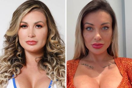 Andressa Urach revela complicaes aps cirurgia para mudar a cor dos olhos 
