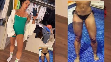 Aline Campos mostra como ficou sua perna ap�s remover tatuagem