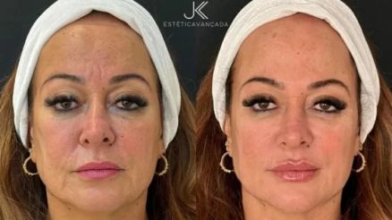 Nadine Gonalves, me de Neymar Jr., realiza procedimento esttico