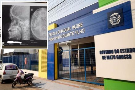 Adolescente teve nariz quebrado (detalhe) por colega na escola E. E. Padre Firmo Pinto Duarte Filho
