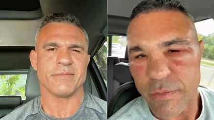 Vitor Belfort mostrou rosto inchado aps implante capilar -