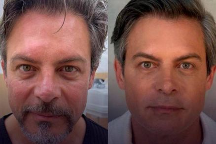 Antes e depois do procedimento no rosto de Luigi Baricelli 