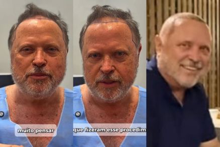 O ex-governador Blairo Maggi: antes e aps o transplante capilar