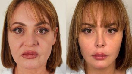 Gaby Spanic surpreendeu ao mostrar harmonizao facial -