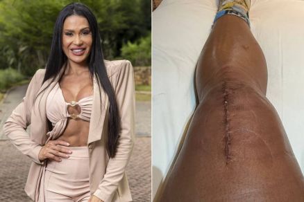 Gracyanne Barbosa mostra diferena entre as pernas aps cirurgia 