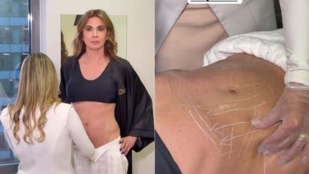 Luciana Gimenez mostrou procedimento de beleza para recuperar abdmen 
