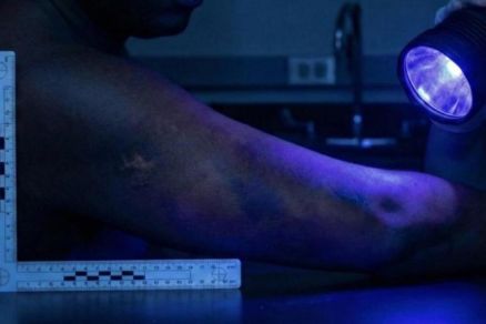 Luz forense sendo usada para visualizar hematomas em pessoas negras