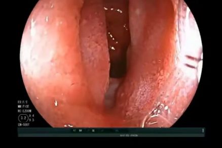 ENDOSCOPIA