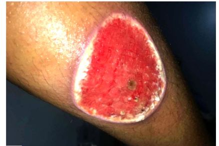 queimadura